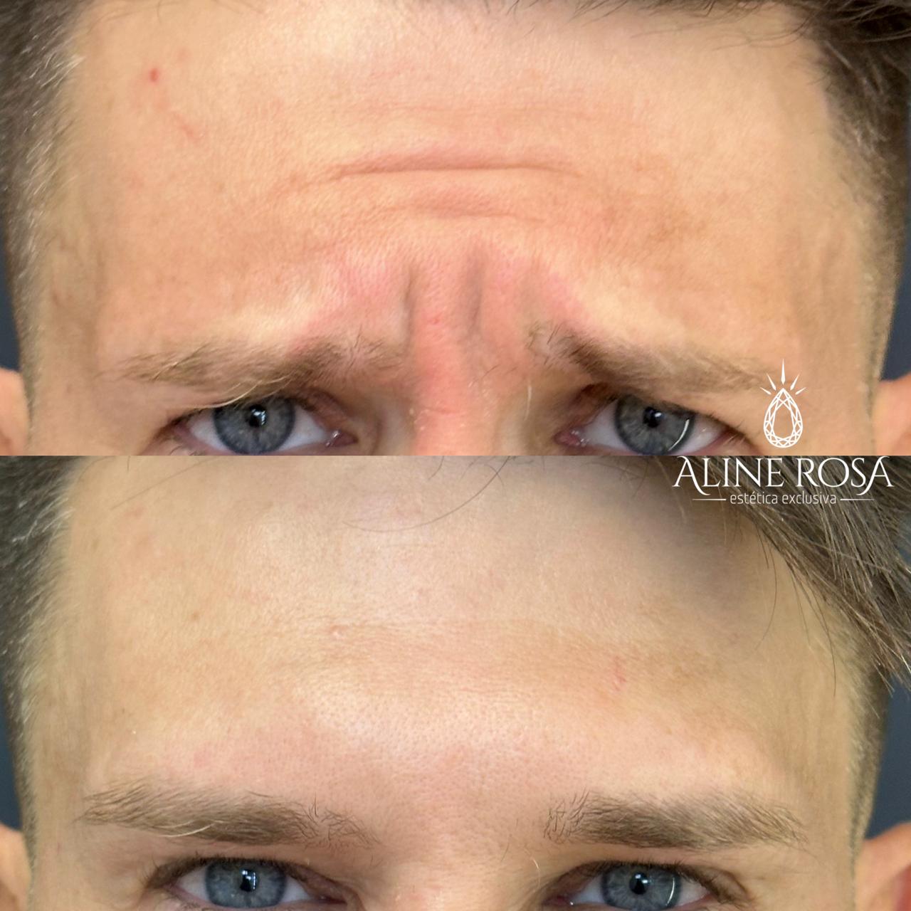 Botox Terço Superior Masculino